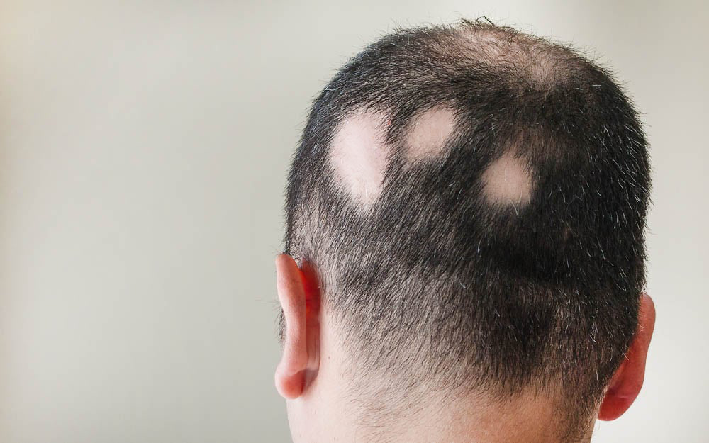 γυροειδής αλωπεκία